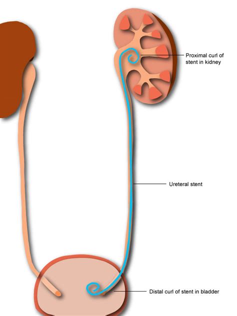 Urinary Tract Stent Procedure
