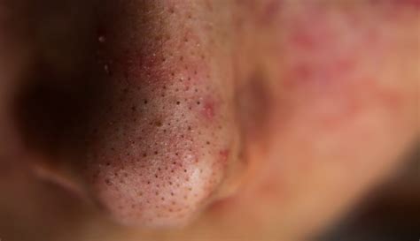 What Are Blackheads