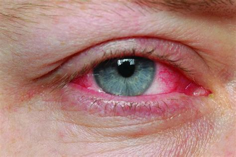 What Causes Pink Eye