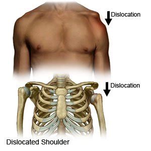 What Does It Feel Like Dislocated Shoulder