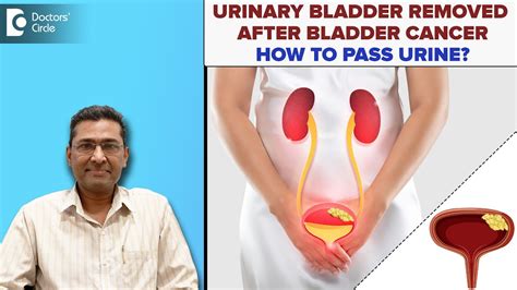 What Happens When They Remove Your Bladder
