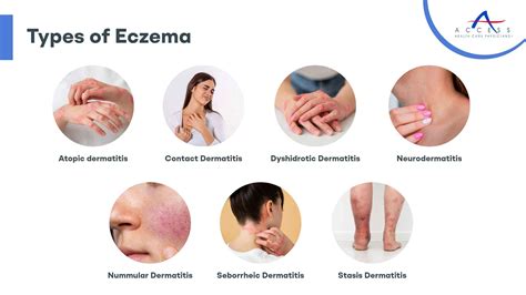 What Is A Eczema