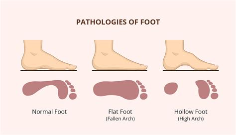 What Is Flat Feet