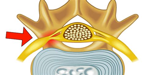 What Is Foraminal Stenosis