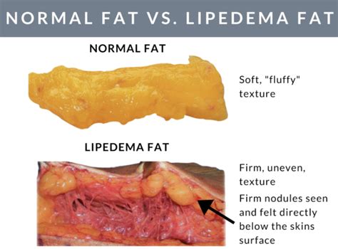 What Is Lipedema Fat