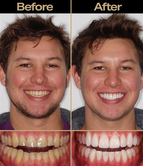What Is Teeth Bonding