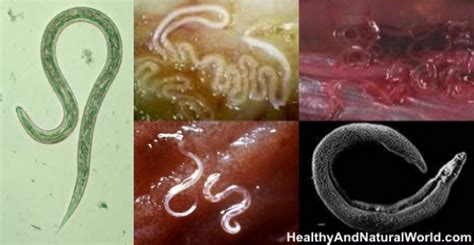 What Kills Worms In Humans