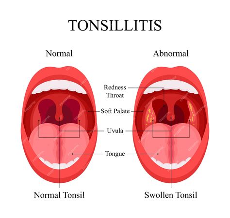 What Tonsils Are For