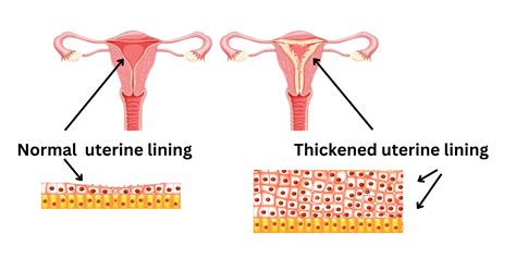 What Triggers Uterine Lining To Start Shedding