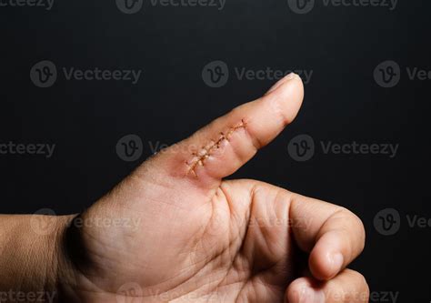 When To Get Stitches