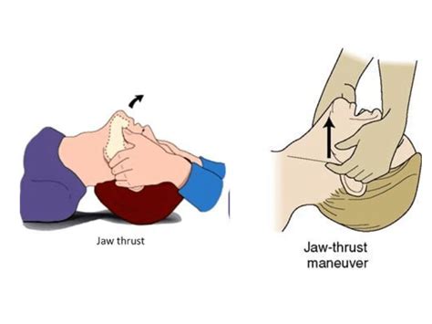 When To Use Jaw Thrust Maneuver