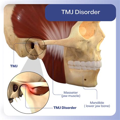 Who Treats Tmj