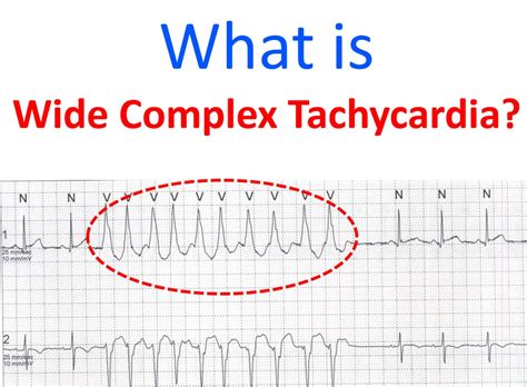 Wide Complex Tachycardia