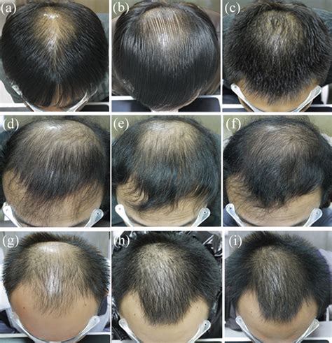 Will Finasteride Regrow Hair